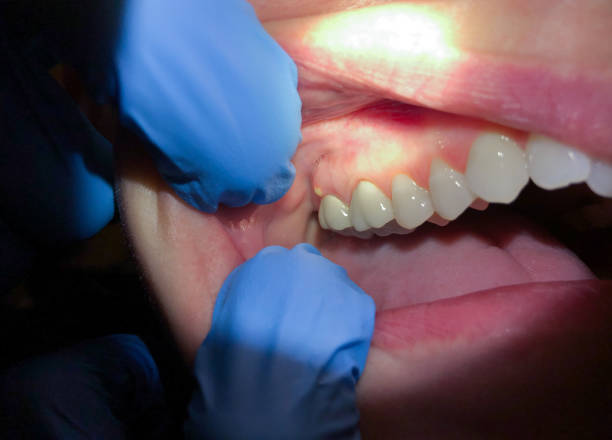 Best Emergency Care for Gum Disease in Arcola, IL