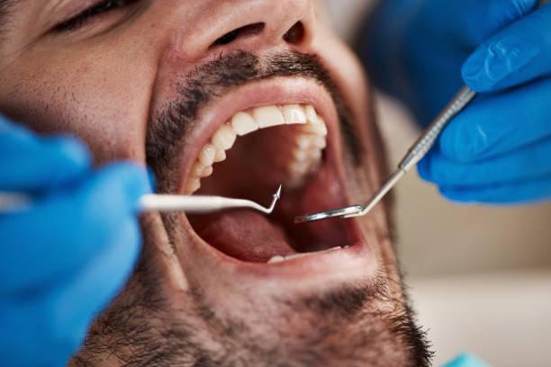Best Emergency Wisdom Tooth Extraction in Arcola, IL